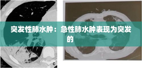 突发性肺水肿：急性肺水肿表现为突发的 