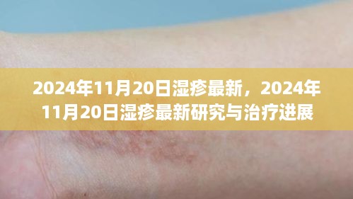 2024年湿疹最新研究与治疗进展