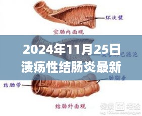 实战指南，溃疡性结肠炎最新治疗办法实战步骤指南（初学者与进阶用户适用，2024年）