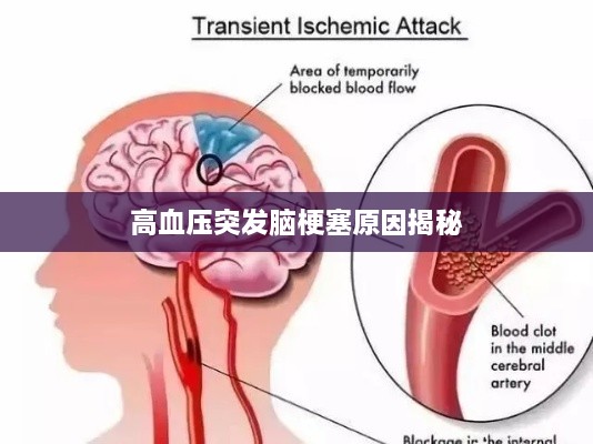 高血压突发脑梗塞原因揭秘